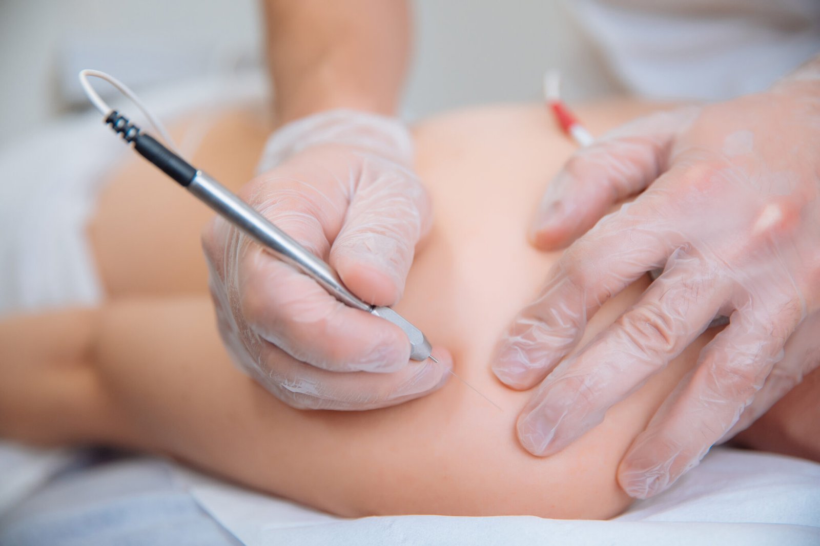 Electroacupunture dry needling needle connecting machine to needles used by acupunturist on patient for acupunture guided by EPI Intratissue Percutaneous Electrolisis.